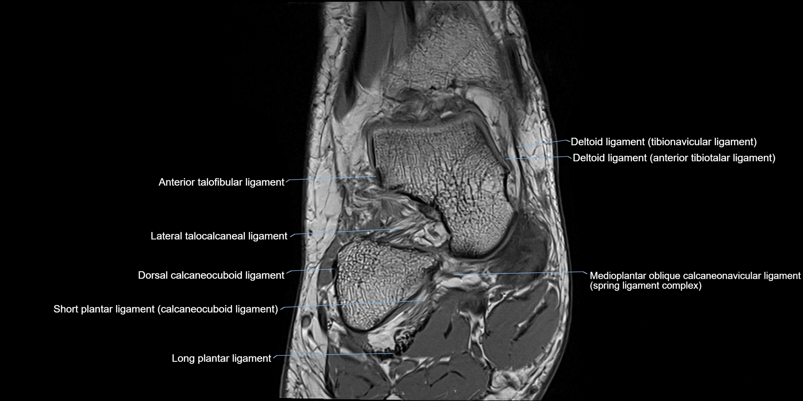 MRI Ankle coronal ligaments cross sectional anatomy 3T  radiology  image-img-00001-00006.webp
